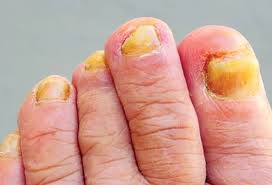 Fungal nail care photo